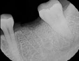 bayside periodontics dental implants