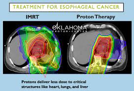 proton radiation oncology pllc