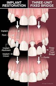 dental implants vs bridgework dear