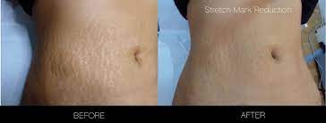 laser stretch mark removal in toronto