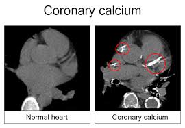 coronary calcium scan