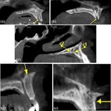 cone beam ct images showing a maxillary