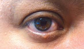 eyelid lumps and ps desert health