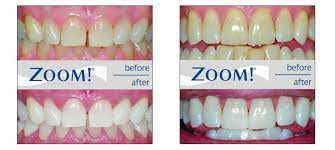 professional zoom teeth whitening