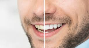 zoom vs laser teeth whitening in
