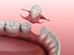 dental bridge vs tooth implant which