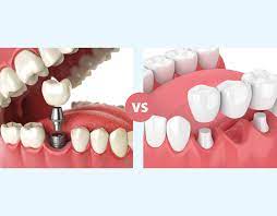 dental implants vs bridges finding