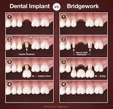 dental implants vs bridgework