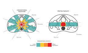 prostate cancer treatment scca proton