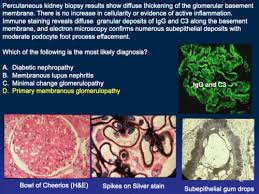 Renal Glomerular Disease Problem