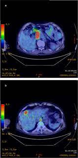 proton beam therapy