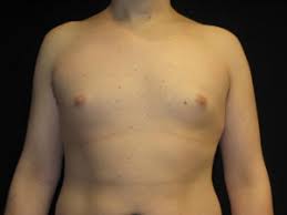 gynecomastia before and after pictures