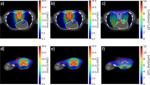 cranio spinal irradiation with protons