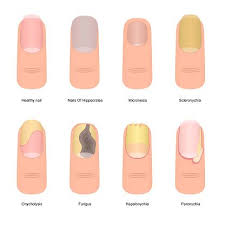 Nail Colors Toenail Problems Toe Nails