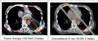 esophageal cancer