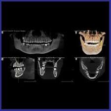 dental x rays navii dental care