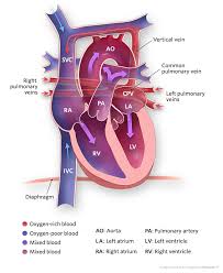 Total Anomalous Pulmonary Venous