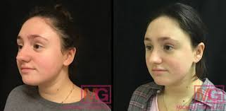 vbeam before after photos dr