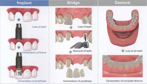 dental implants vs bridges gary nack