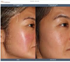 rosacea treatment philadelphia main