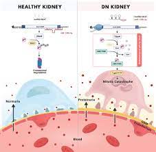 Diabetic Nephropathy