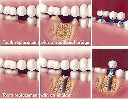 dental bridge vs implant which is
