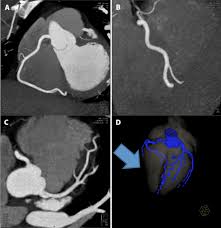 cardiac ct angiography