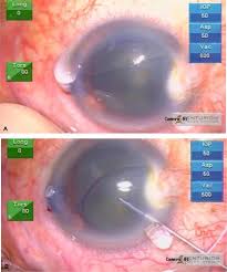 Membrane Detachment