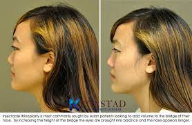 best asian rhinoplasty with injectable