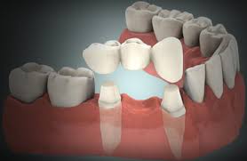 dental implants vs bridges and partial