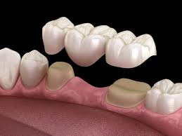 dental bridges will complete your