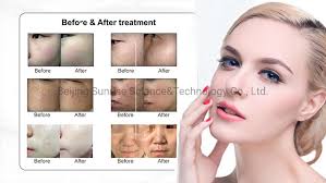 skin resurfacing acne scar equipment