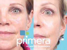 pulsed dye laser skin treatments for