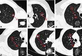 Pulmonary Ground Glass Opacity Nodules