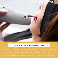 reducing redness with vbeam laser