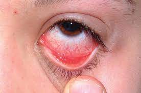 infections of the eye and adnexa in