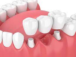 dental implants vs bridges midland