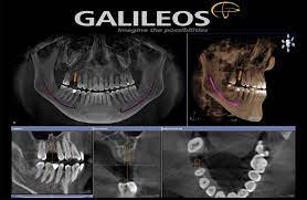 3d dental imaging galileos cone beam