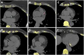 coronary artery calcium scoring model