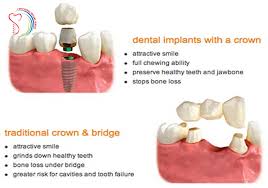 dental bridge vs implant which is better