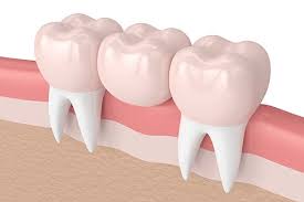 dental bridge vs implant how to know