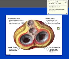 Obstructive Valve Lesions Flashcards