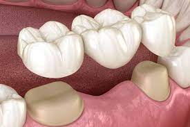 dental bridge or dental implants