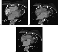 electron beam computed tomography