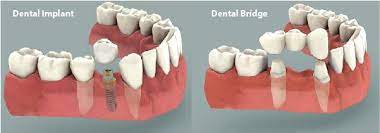 dental bridges vs implant procedures