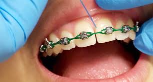 how to floss a dental bridge