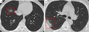 Chest Ct Manifestations Of New