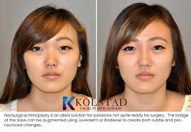 best asian rhinoplasty with injectable