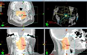 3d treatment planning system varian