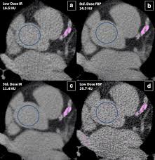 low radiation dose calcium scoring